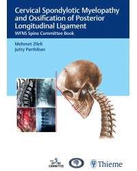 Cervical Spondylotic Myelopathy and Ossification of Posterior Longitudinal Ligament